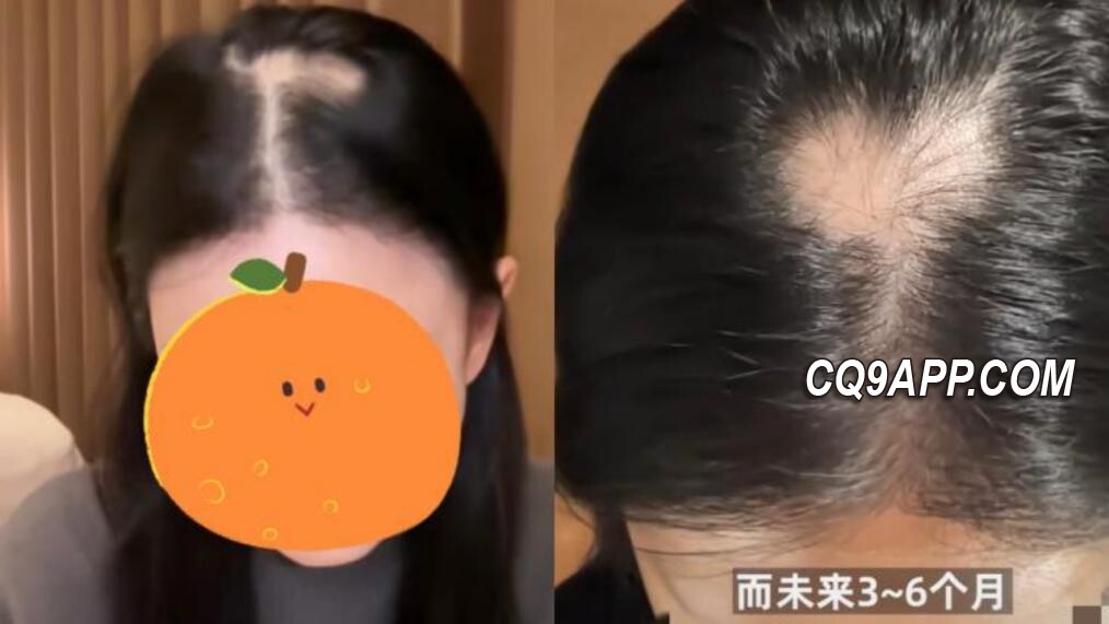 2023120915 网红追求高颅顶美容注射致斑秃 引发公众关注